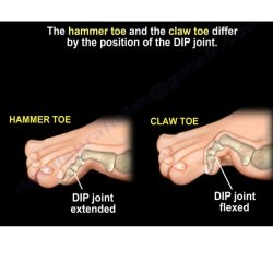 Toes hammertoes diagnosis