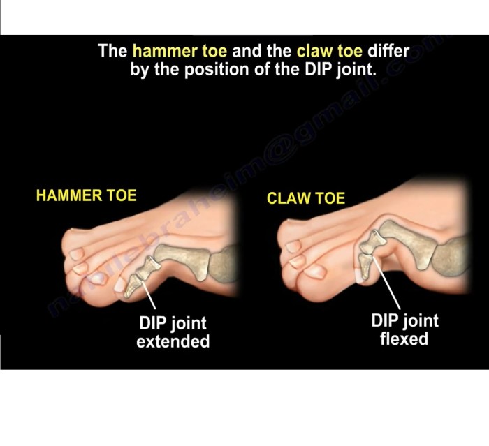 Toes hammertoes diagnosis