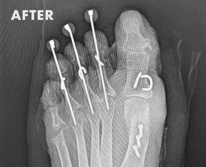 Arthroplasty resection hammertoe deformity joint contracture podiatry