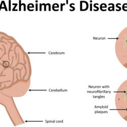 Parkinson keys disease solving clues microscopic tepper studying