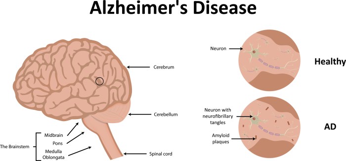 Parkinson keys disease solving clues microscopic tepper studying