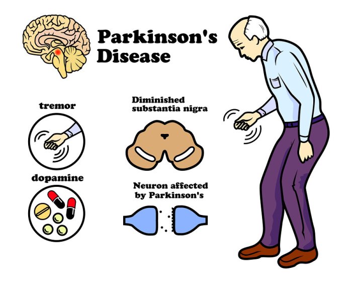 Parkinson diseases neurons dopaminergic chronic nigra substantia pigmented neuroscience affected neuron parkinsons individuals neurodegeneration populations alterations correlated deficiency synaptic axonal